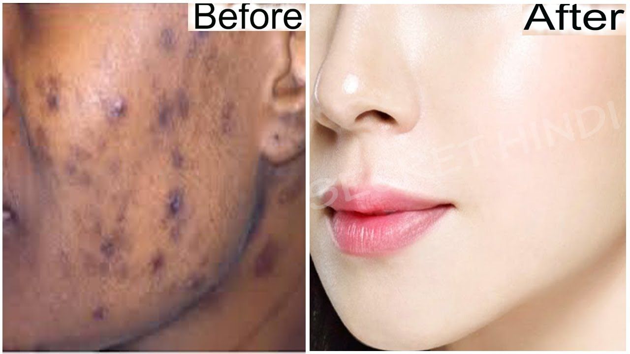 Bombay reccomend Permanently removing facial scars